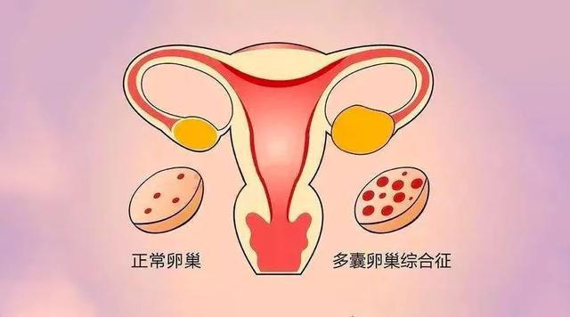 科普｜多囊患者如何通过生活方式干预助力备孕（一）